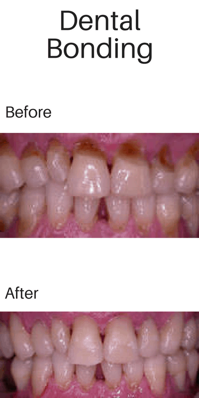 Before image of teeth