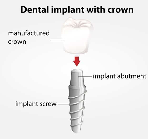dental implant with crown
