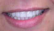After-front teeth whitened and repaired