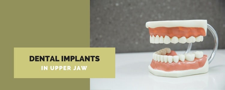 Upper Jaw Dental Implants