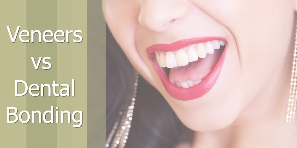 veneers vs dental bonding