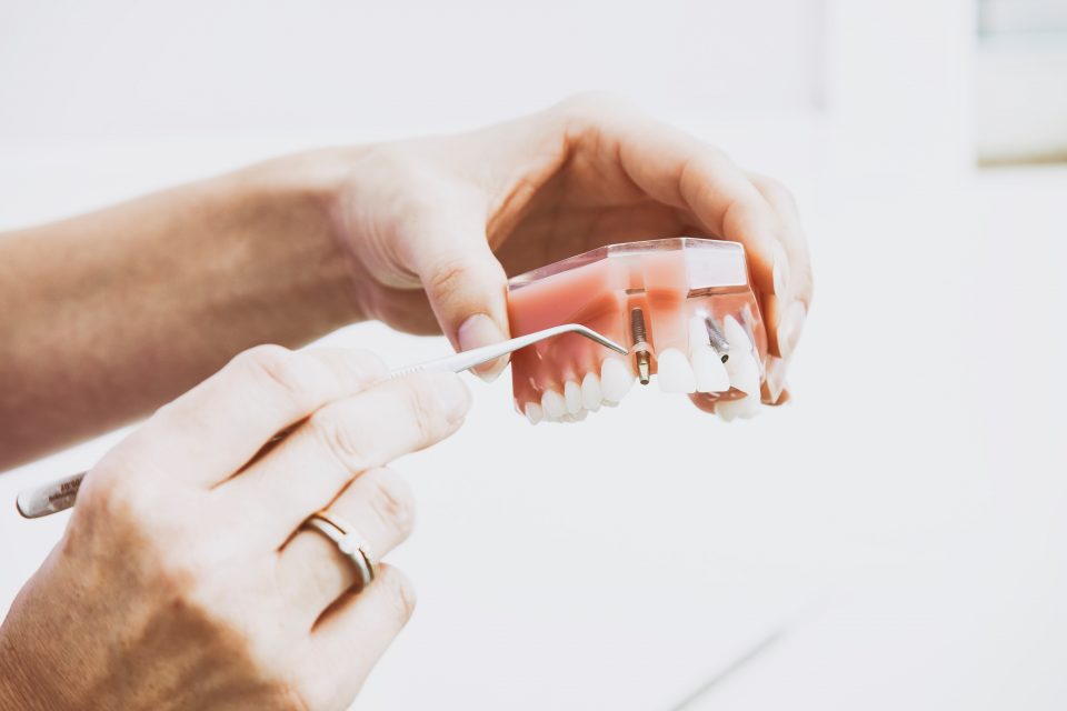 Titanium dental implant inserted in gums