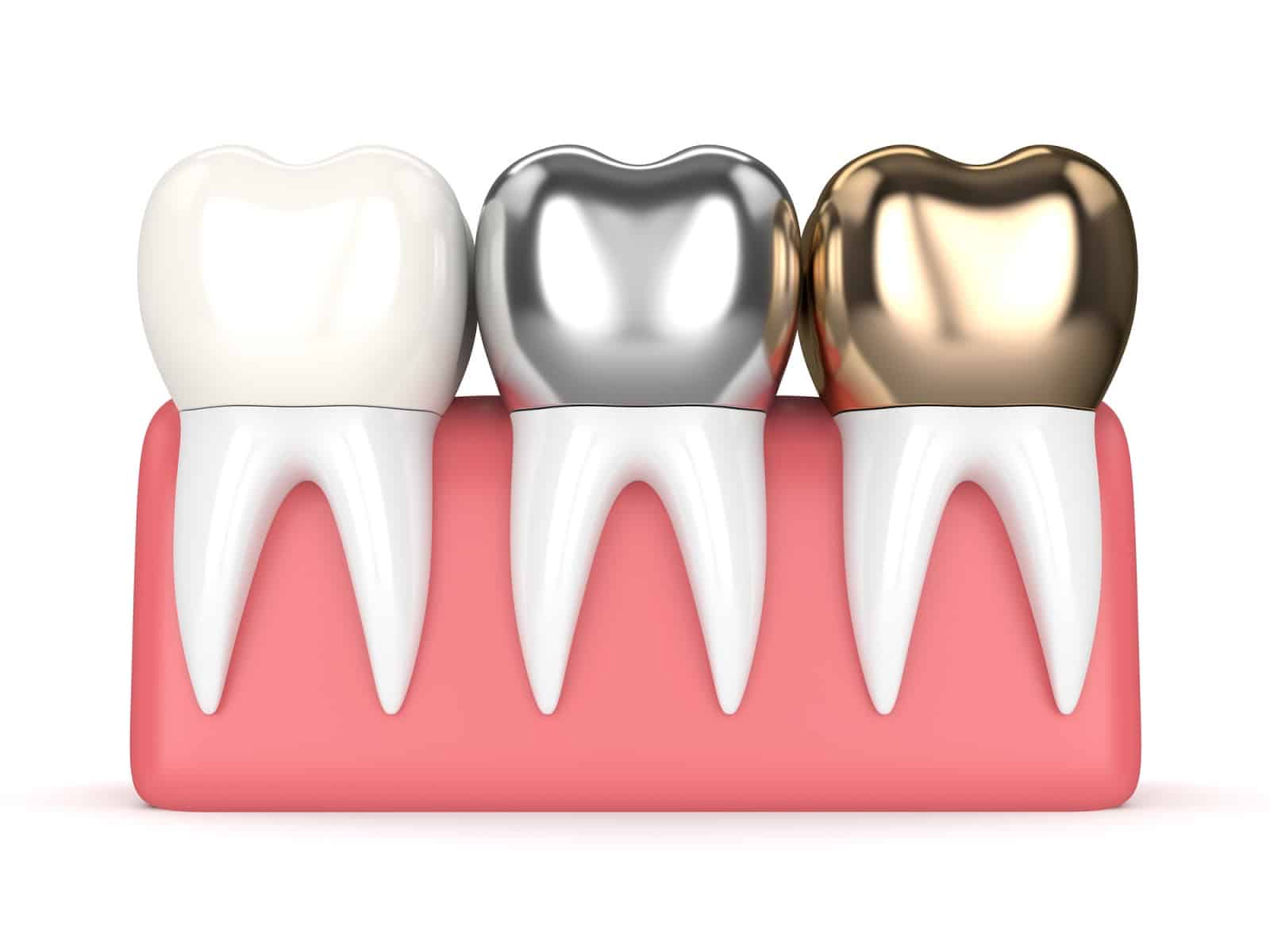 3d render of teeth with gold, amalgam and composite dental crown in gums over white background