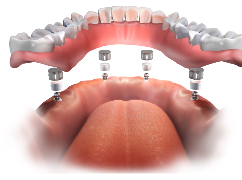 An artist's representation of the type of implant-supported dentures available to people looking for dentures in Burnaby at VCCID