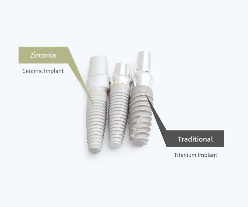 A photograph showing typical titanium dental implants alongside the kind of metal-free zirconia implants available at VCCID in Burnaby