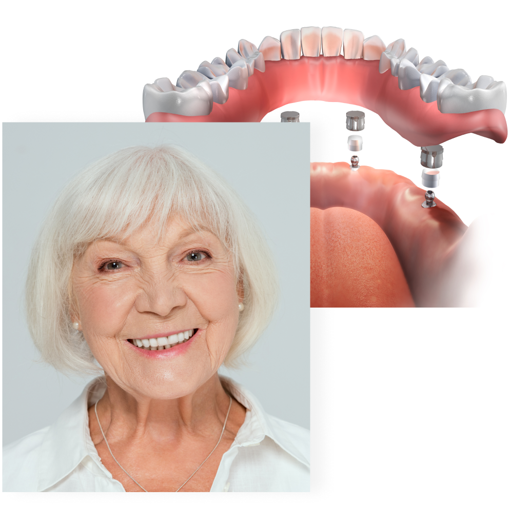 A pair of illustrations showing the structure of a full arch restoration as well as the feeling of satisfaction that a person can feel after restoring their smile with full mouth dental implants in Burnaby at VCCID