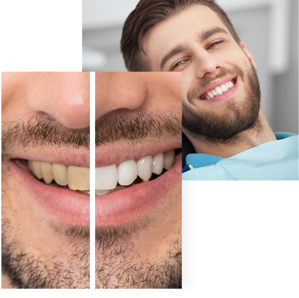 A pair of images showing how teeth whitening in Burnaby at VCCID can remove staining and significantly improve the brightness of a person's smile