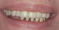 before implant crowns