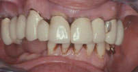 Failing upper crowns and teeth due to gum disease