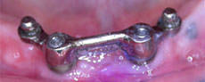 2 implants with a permanent bar for attaching a lower denture