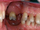 Missing teeth showing collapse of bite, shifting and splaying of 