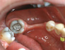 Severe loss of bone due to missing teeth